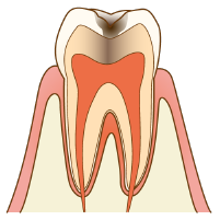 虫歯