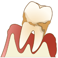 歯周病