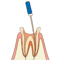 根管治療
